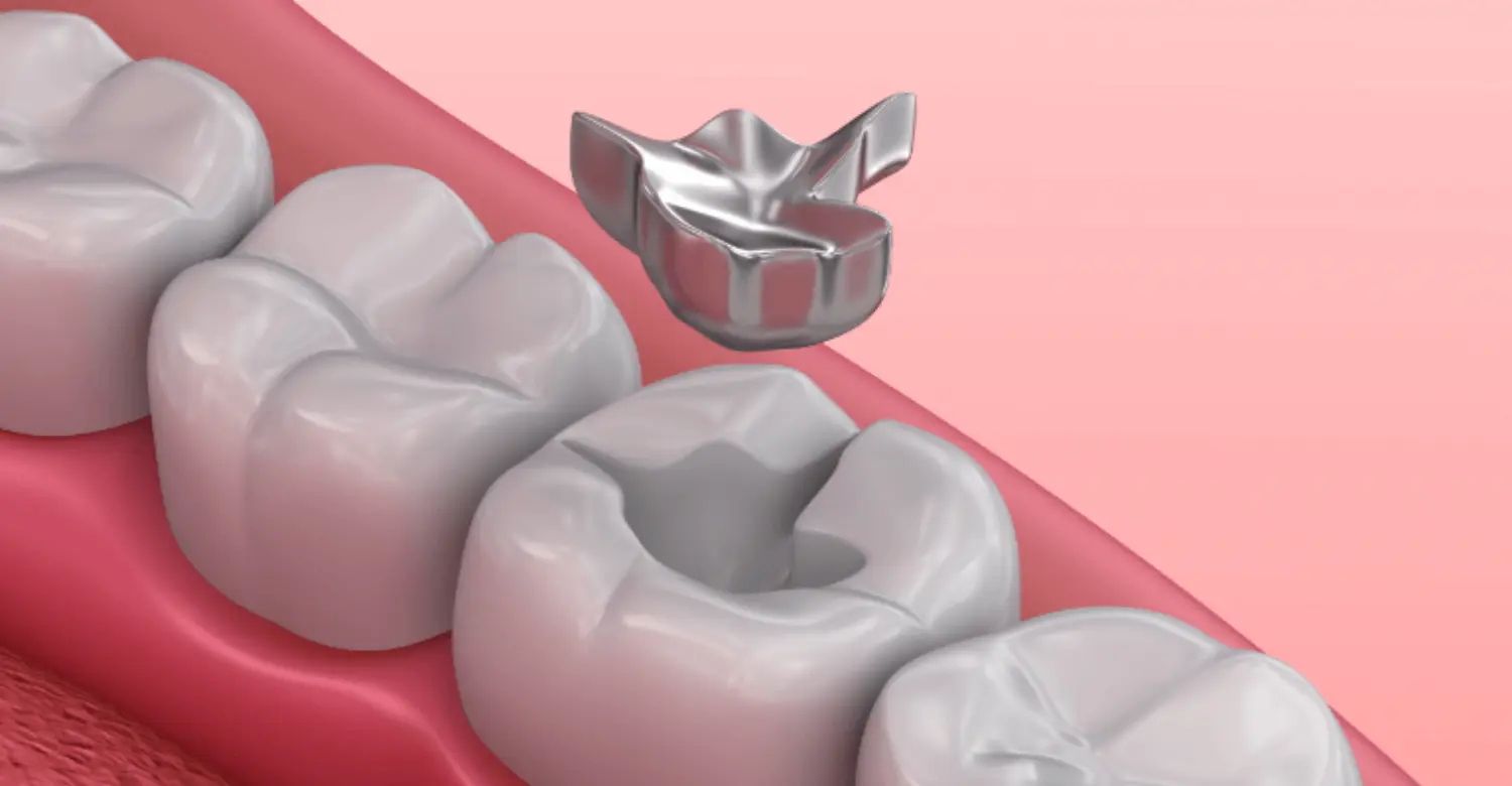 Amalgam Filling 2